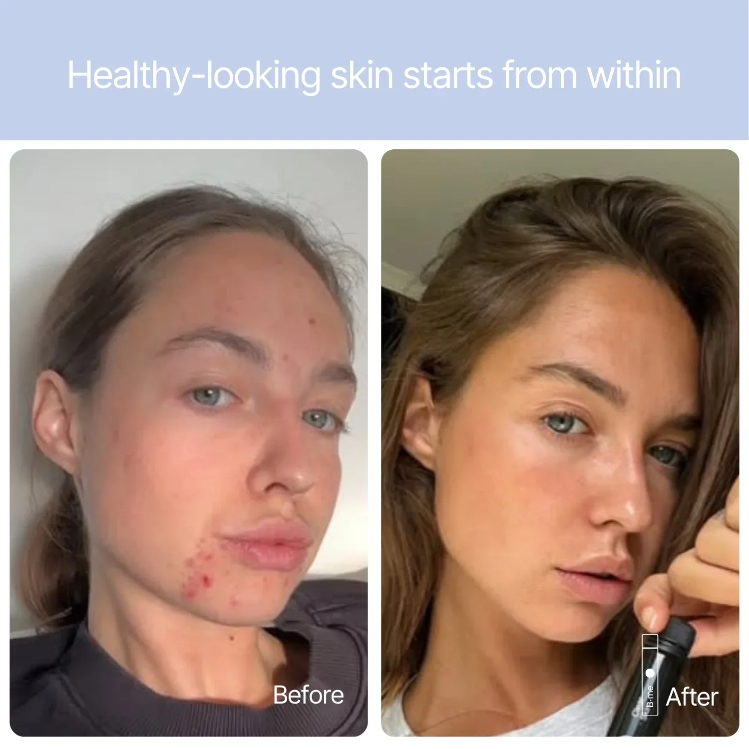 bme-clear-skin-before-after-face.webp