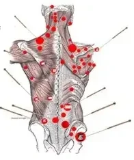  What is Dry Needling?