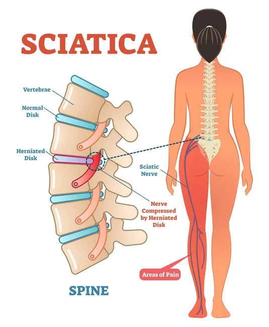 Outline of the back of a female, showing the spine and the sciatic nerve. A zoomed-in side-angle view of the spine with labeled parts to show disks, vertebrae, and compressed nerve.