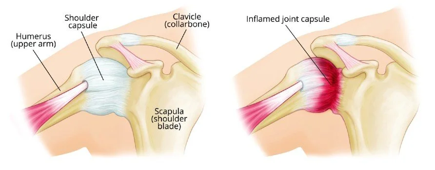 example of normal and inflamed shoulder