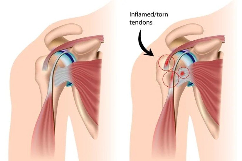 Can physiotherapists help with a Rotator Cuff Tear? — Mainway