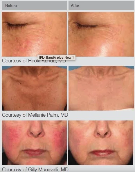 Illuminating Beauty: The Transformative Power of IPL Photo Facials 