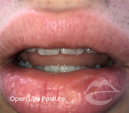 OpenLipsPosture.png