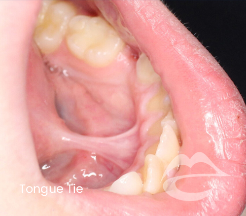 TongueTie.png
