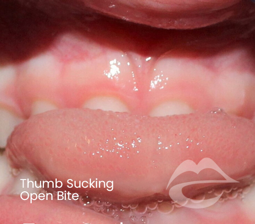 ThumbSuckingOpenBite.png