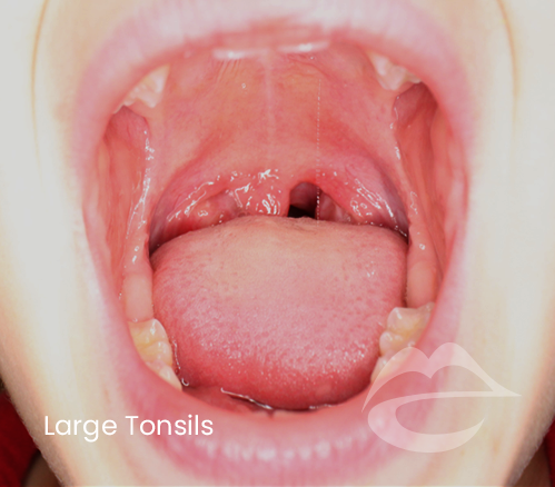 Large-Tonsils.jpg