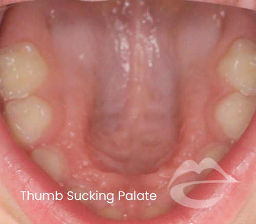 ThumbSuckingPalate.png
