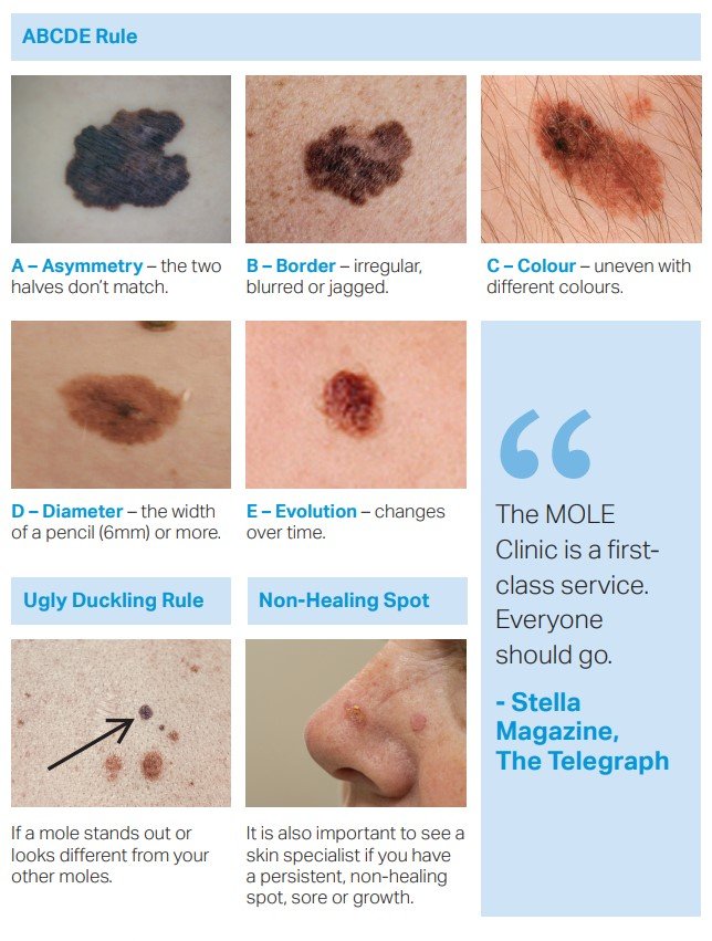 cancerous moles vs normal moles