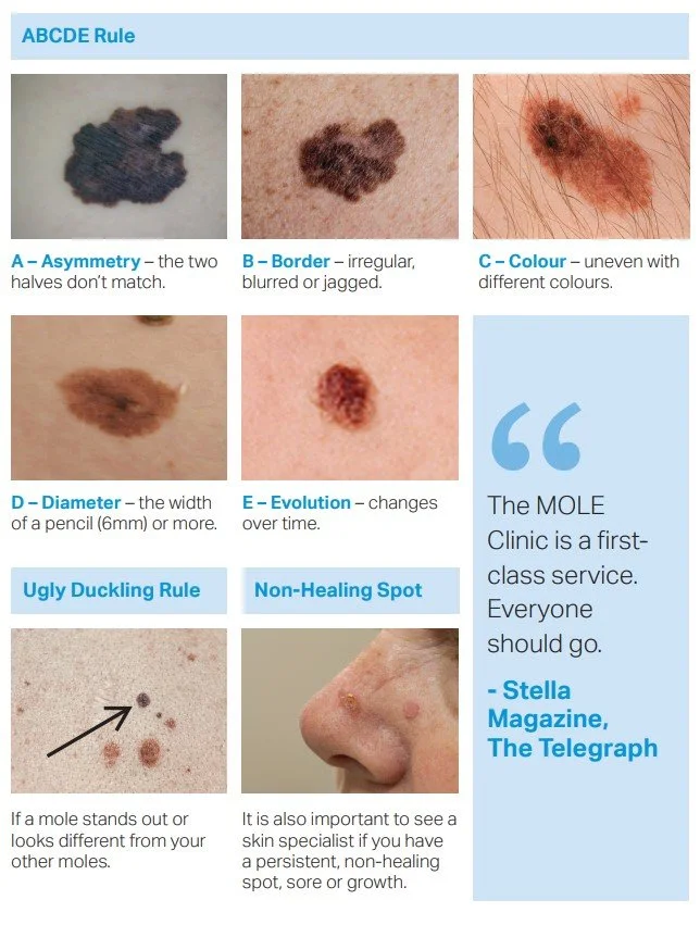 Normal Moles Vs Abnormal Moles Mole Atypical Atypical Nevus 