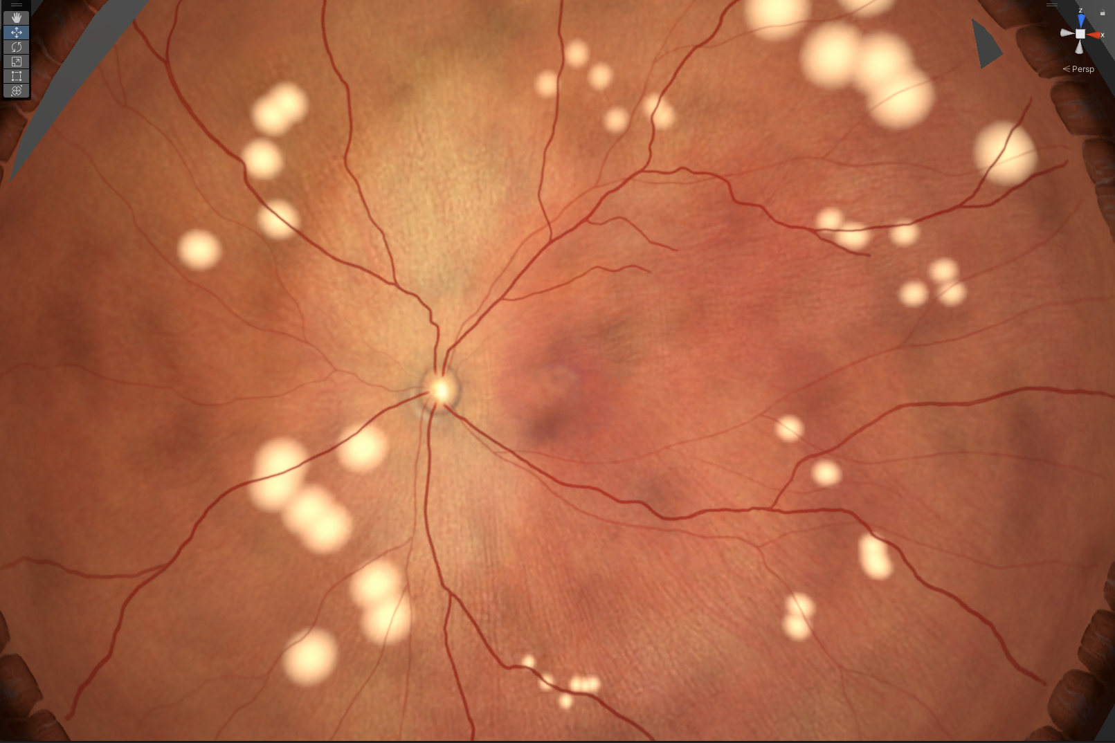 Laser photocoagulation