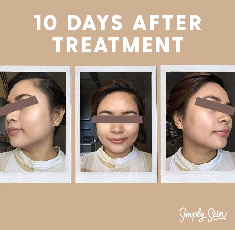 Pixel Skin Treatment Before And After – YVDL