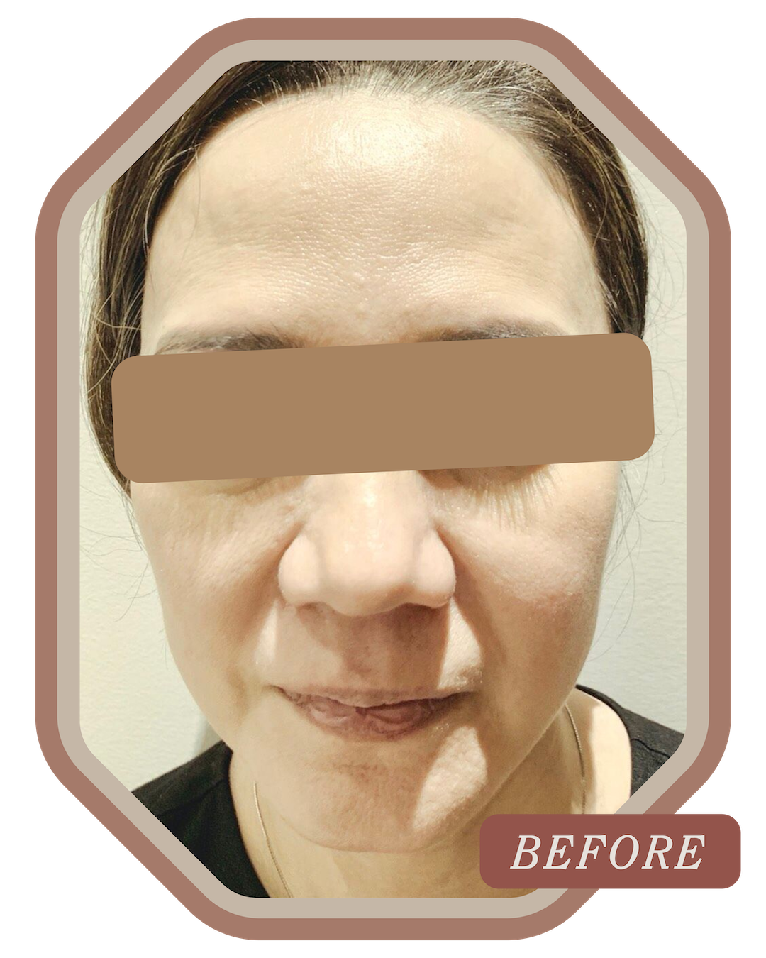 SS_Progress_Photo_Ultherapy_1_Before.png