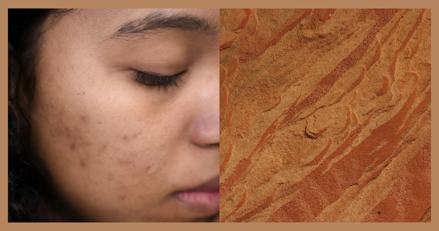 Beyond the Breakout: How to Fade Stubborn Acne Marks