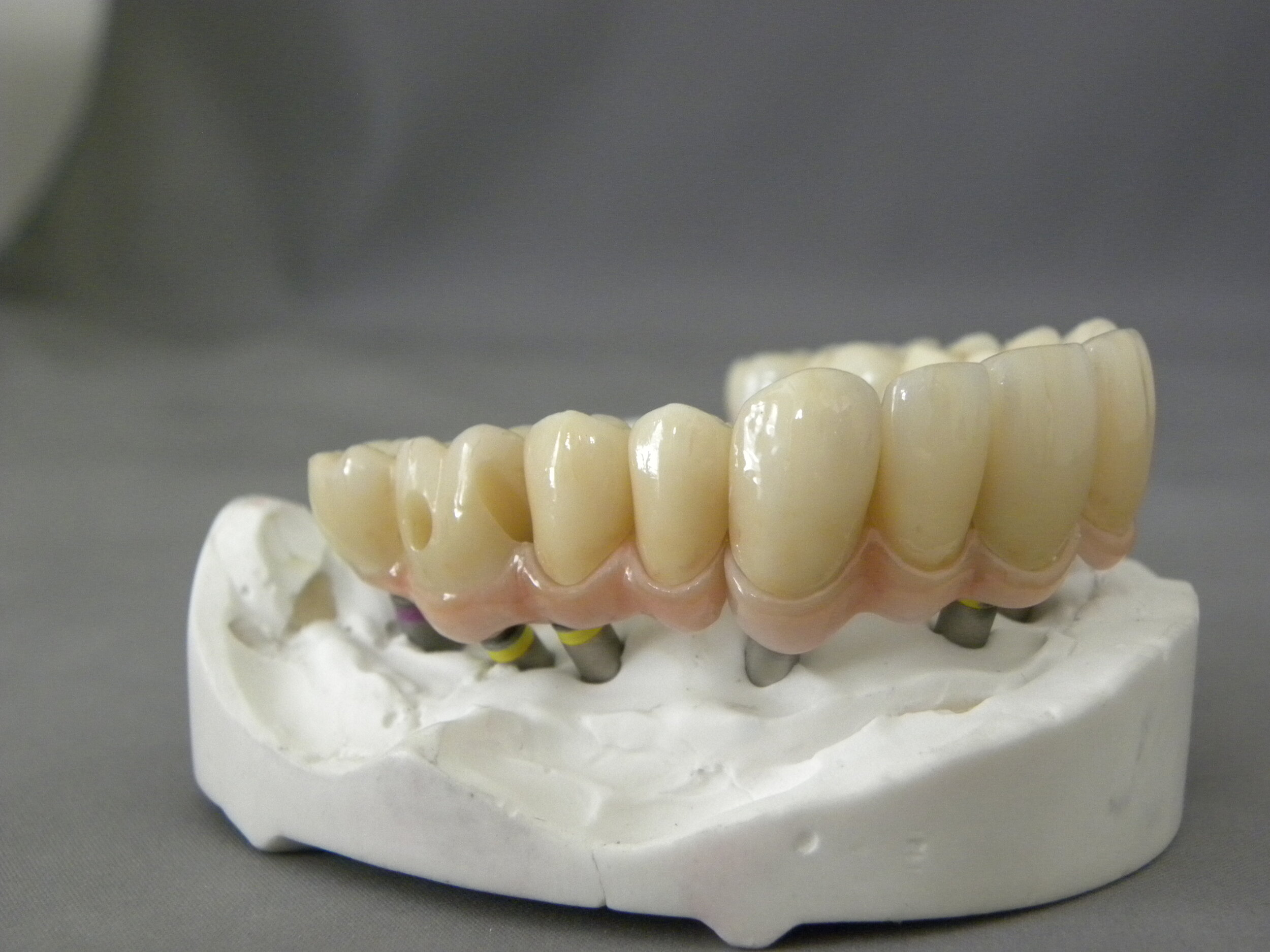 European Dental Implant Market Insights, 20192025 — Masters Dental Lab