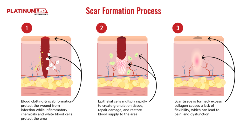 Scar tissue: Causes, prevention, and treatment