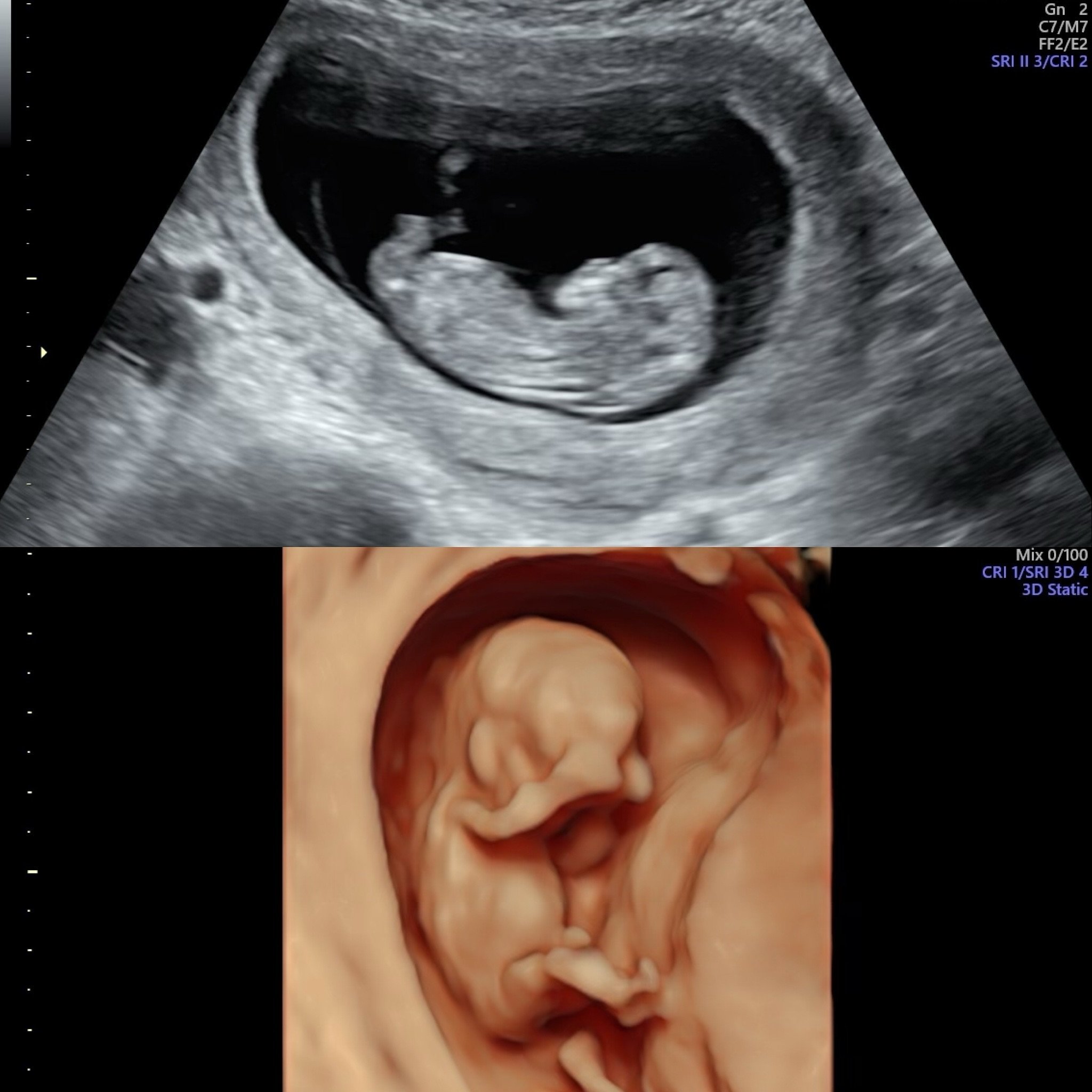 11w5d! Such a fun time to do 3D&rsquo;s and see all of baby. This would be the Mini 3D/4D/HD package 🤗