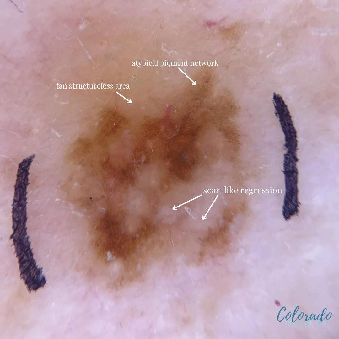 Some not-so-aesthetic content ⁣&hellip;. ⁣
⁣
(Inspired by @dermoscopyislit / thank you x a million for incredible dermoscopy content.)⁣
⁣⁣
This is a melanocytic (mole) lesion under dermoscopy (that hand-held light device I am always carrying around).