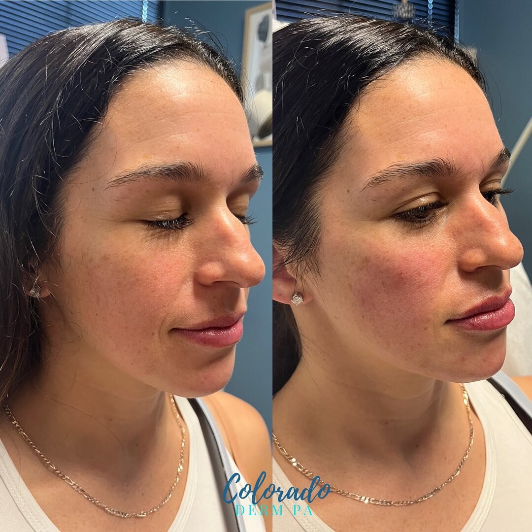 This new mama is looking refreshed, refined, and natural. Obsessed with these results. Can&rsquo;t wait to see her when the Botox kicks in! ⁣
⁣
💉: RHA at cheeks, perioral shadowing, mental crease, and chin ⁣
💋: Revanesse⁣
+ Botox (will kick in in 2