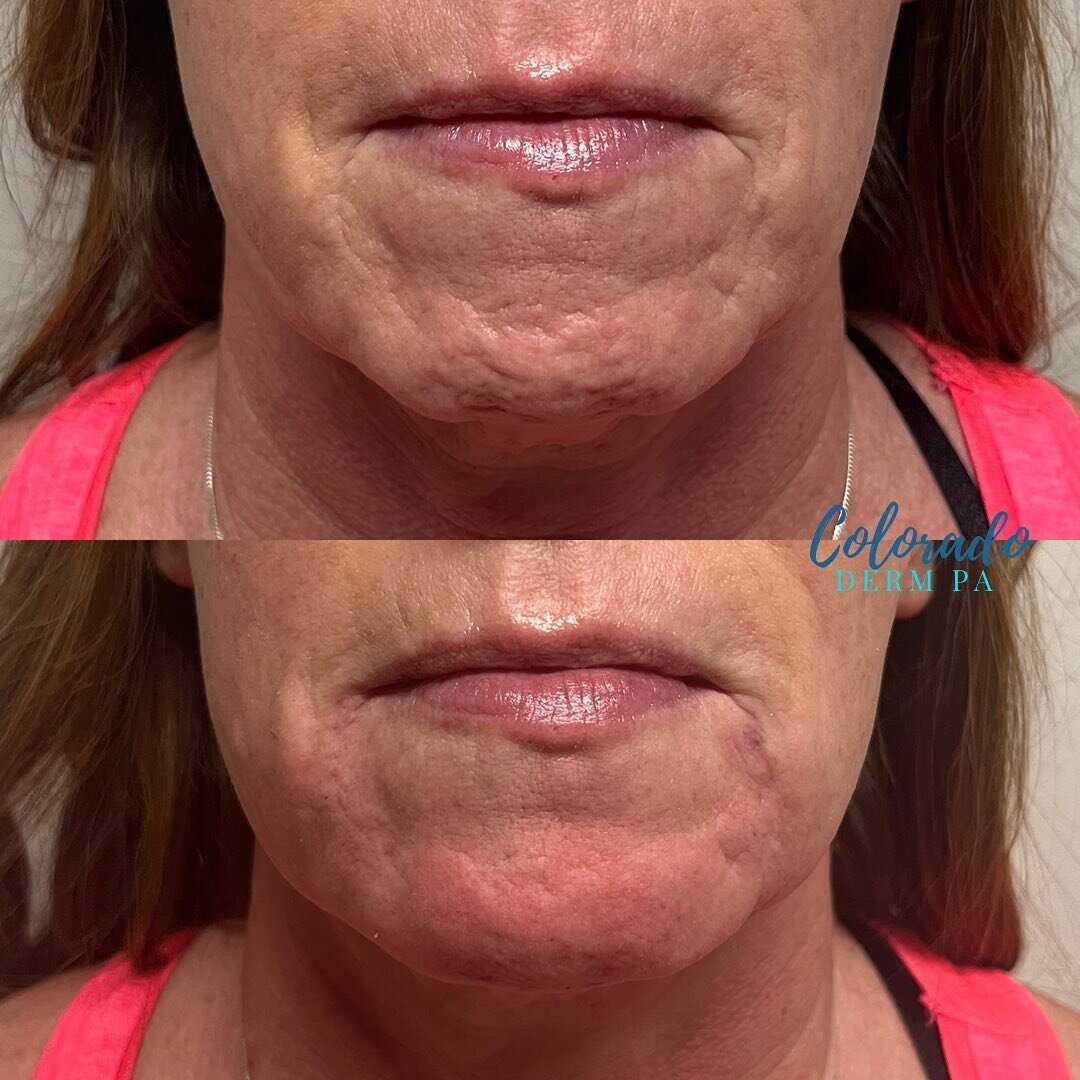 Alright RHA I see you&hellip;and I&rsquo;m OBSESSED! ⁣
⁣
This patient would be someone who before RHA, I would have advised laser for her acne scars on her chin but now I have an amazing tool in my tool box to better help address skin texture and int