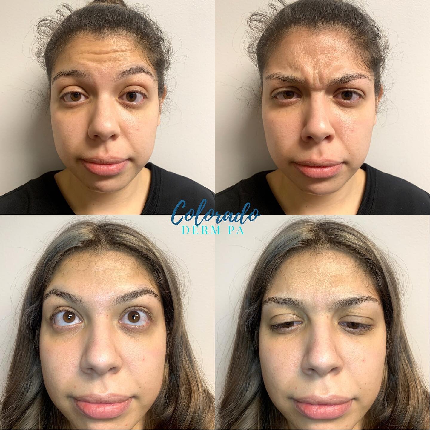 Loving this Dysport B&amp;A for this lovely bride-to-be ⁣
⁣
Photos taken 2 weeks apart. Duration of dysport is typically around 4 months. ⁣
⁣
Interested in Dysport? Come see me at my office! ⁣
⁣
📍2009 W Littleton Blvd, Suite 100 ⁣
Littleton, CO 8021