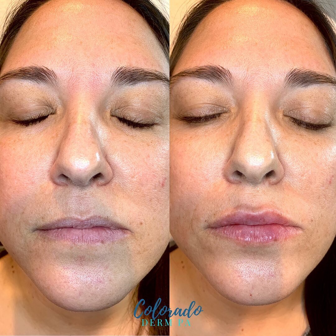 Natural volume achieved ✅ ⁣
⁣
Been loving on lips lately and these are a great example of why.  Subtle, refreshed, natural results. It doesn&rsquo;t get any better than that!⁣
⁣
⁣
⁣
Peak Dermatology ⁣
303-221-4448 ⁣
&mdash;&mdash;&mdash; or &mdash;&m