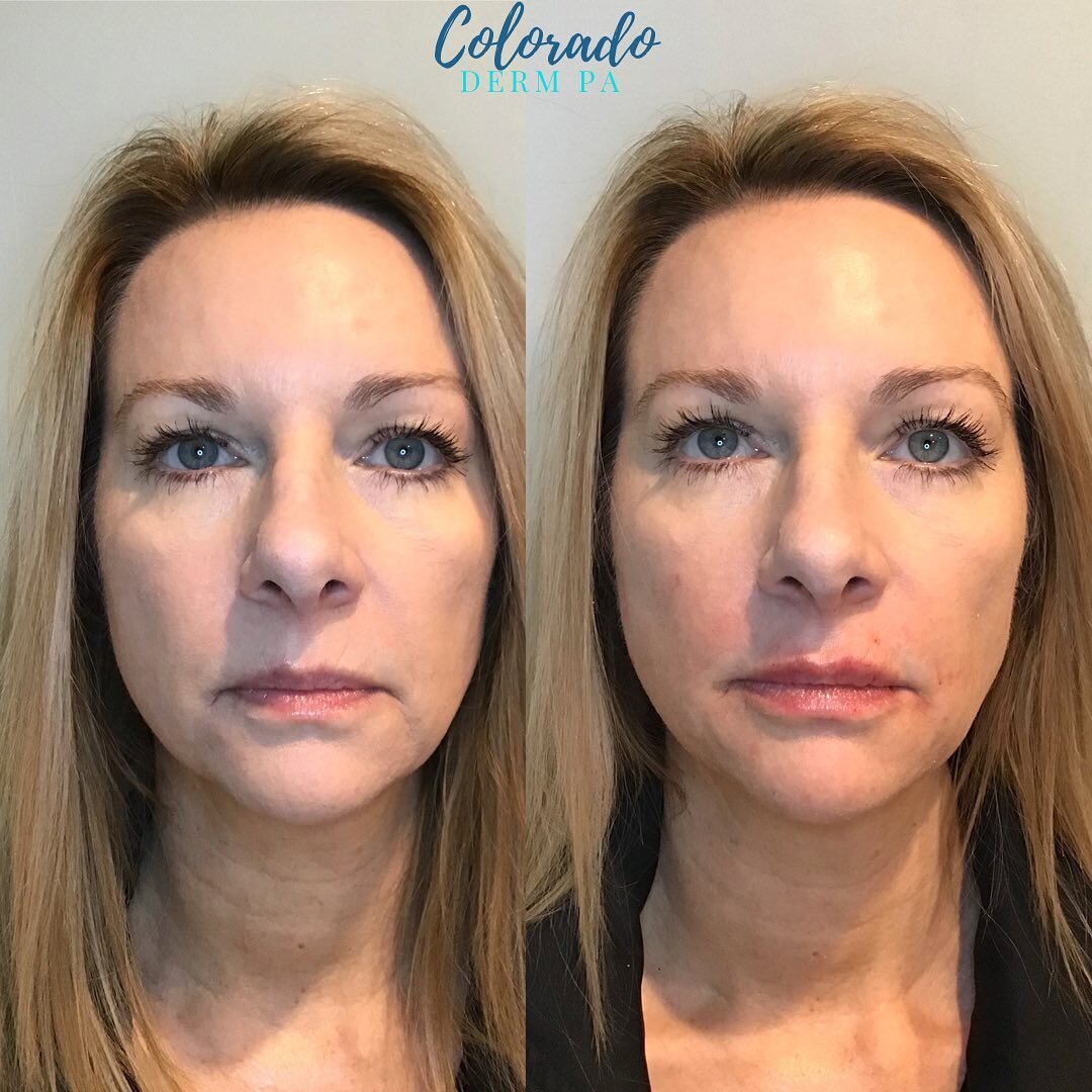 Amazing how just a little bit of lip filler can have such a profound improvement on the overall face ✨⁣⁣
⁣⁣
This beautiful patient has absolutely gorgeous, larger eyes. With her lip filler, she was able to achieve an amazing harmonizing result by bal