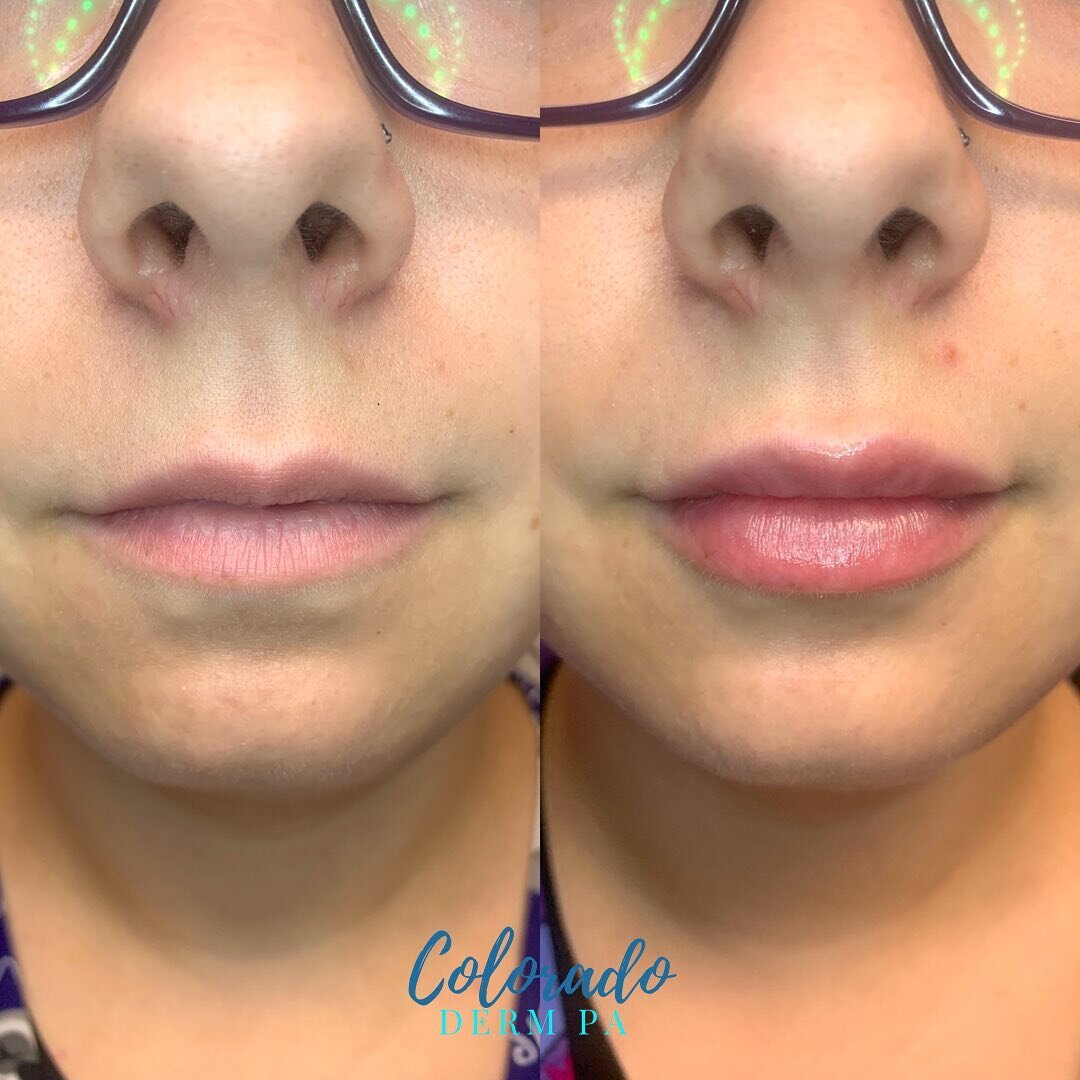 Another lovely set of lips ✨⁣
⁣
After photo taken 4 weeks after injections. Keep in mind it can take several weeks for all the swelling to fully diminish and the hyaluronic acid filler to settle. ⁣
⁣
On another note, I absolutely love the hydration a
