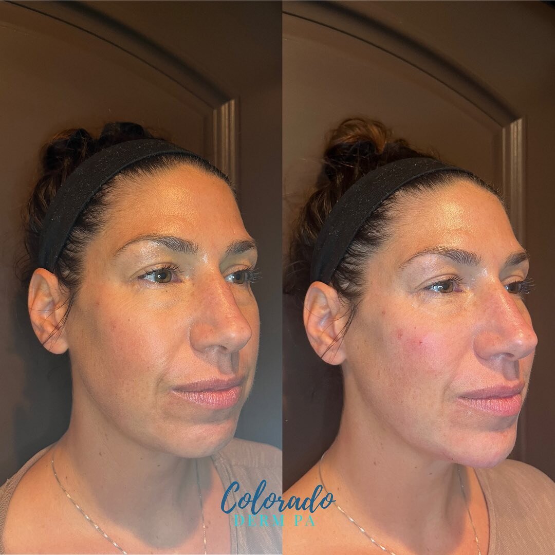 Nothing I love more than a natural cheek and chin session. Helps to slim the face, creates a nice contour pop to the cheek, and evens out the side profile. ⁣
⁣
Will work more on her chin in the future but good improvement with this first session. ⁣
⁣