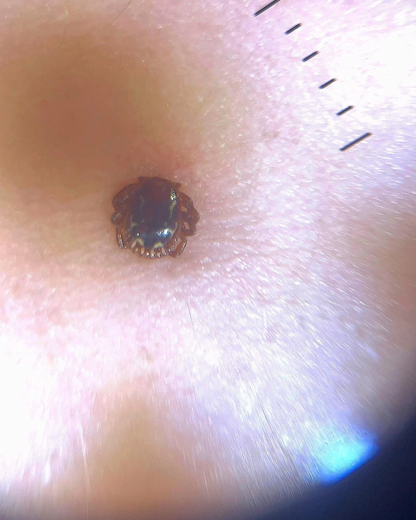 That is most definitely not a mole&hellip;⁣
⁣
This little guy was picked up on a full body skin exam in a patient who had just returned from the southern mid-west. ⁣
⁣
I was able to identify the tick as a Lone Star Tick (adult male) and my concern fo