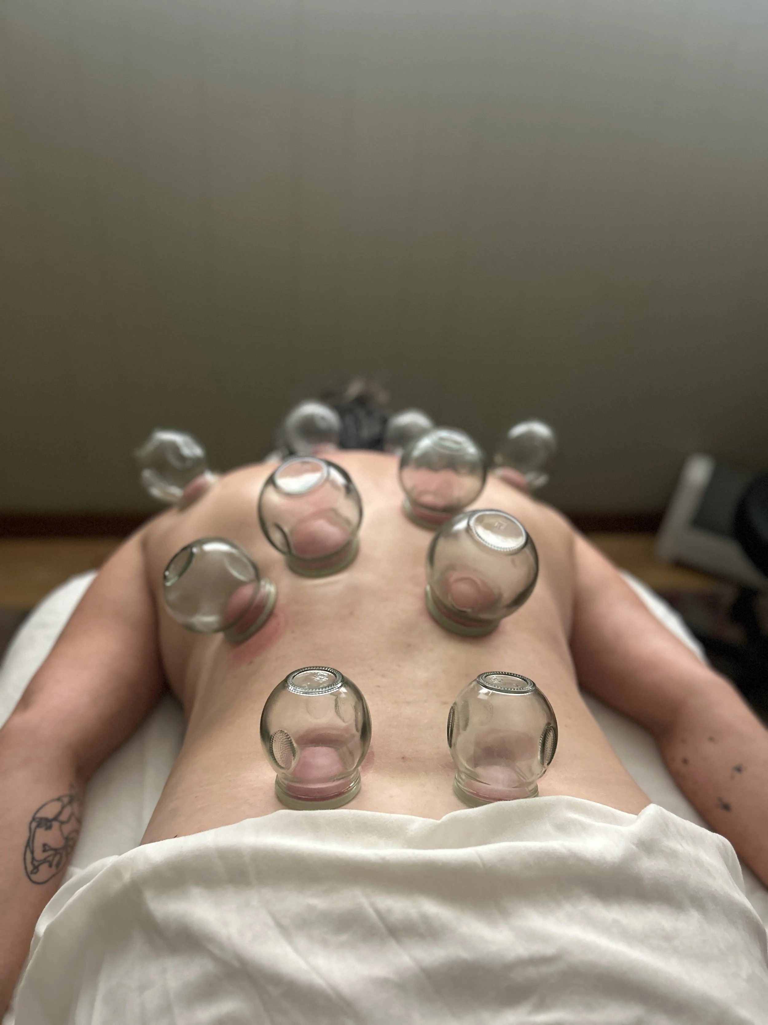 Person lying down with acupuncture or cupping therapy, with glass cups placed on their chest and abdomen.