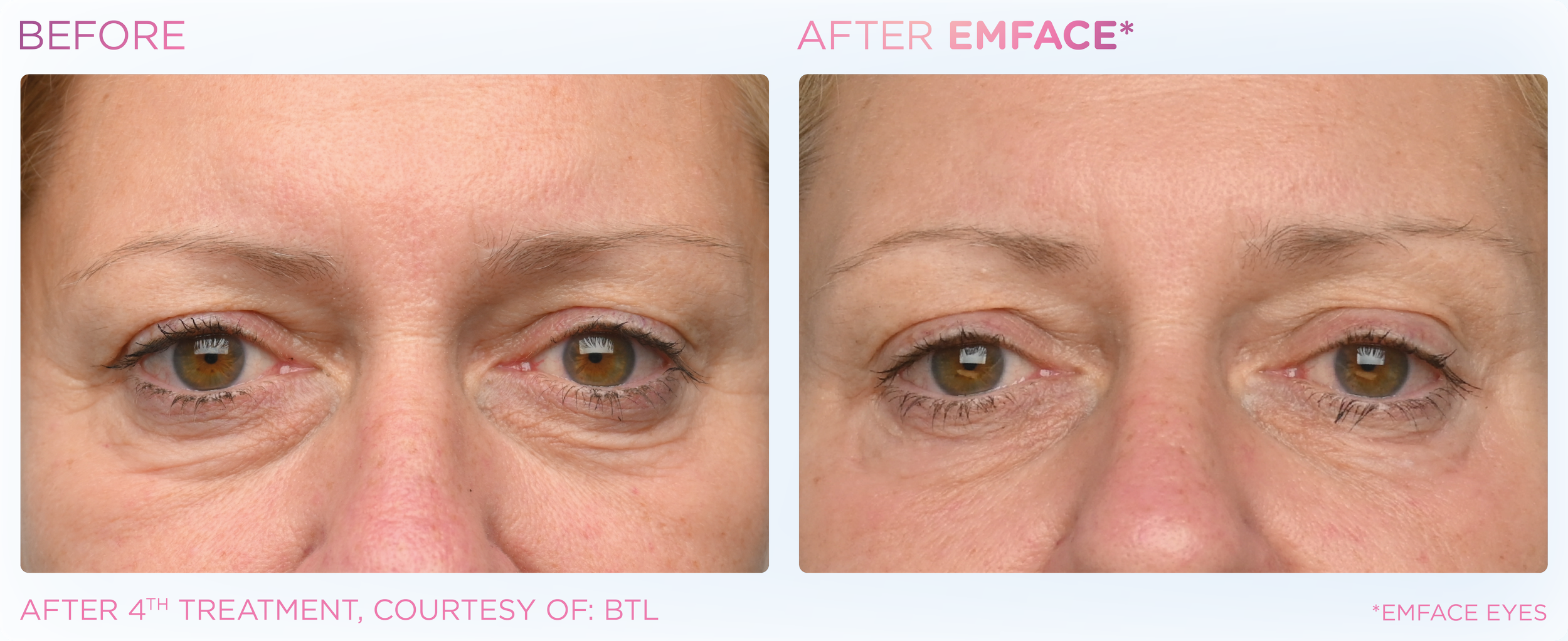Comparison of a woman's eye area before and after fourth treatment with EMFACE, showing reduced wrinkles and skin tightening.