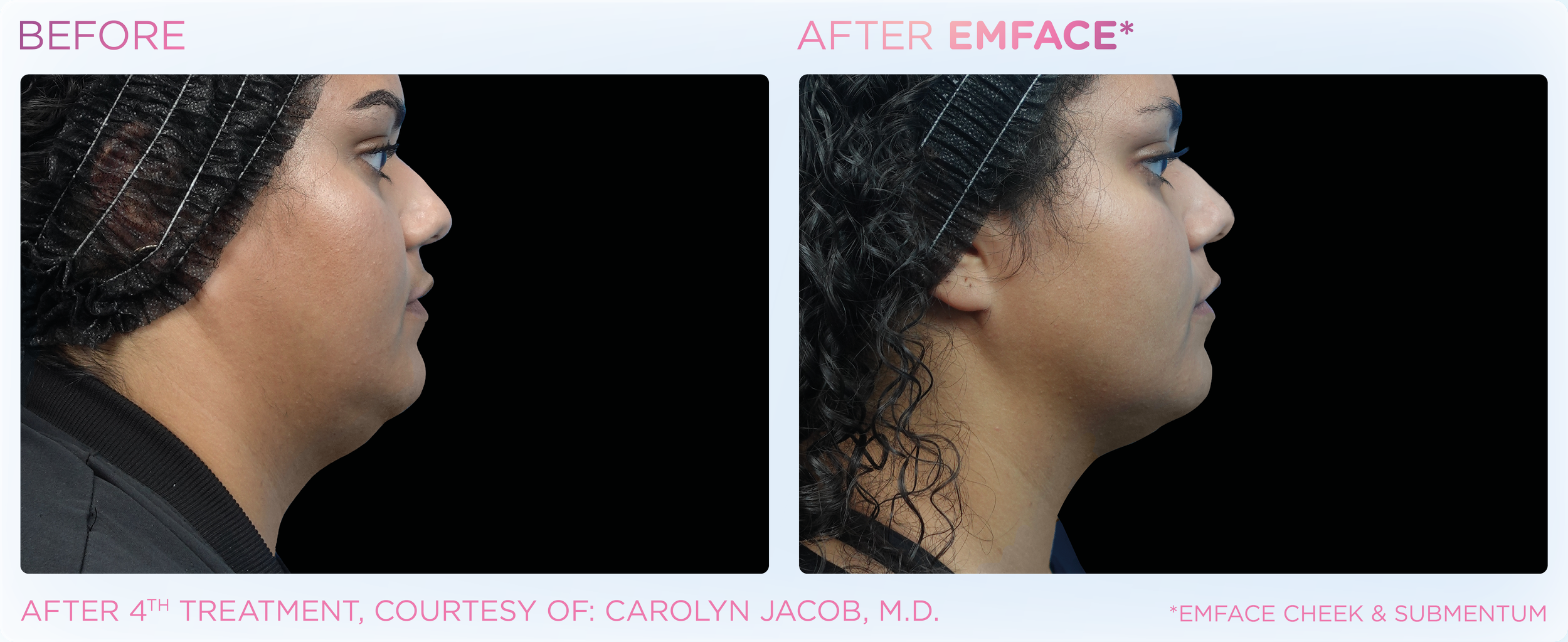 Side-by-side comparison of a woman's profile before and after an EMFACE treatment, showing a tighter jawline