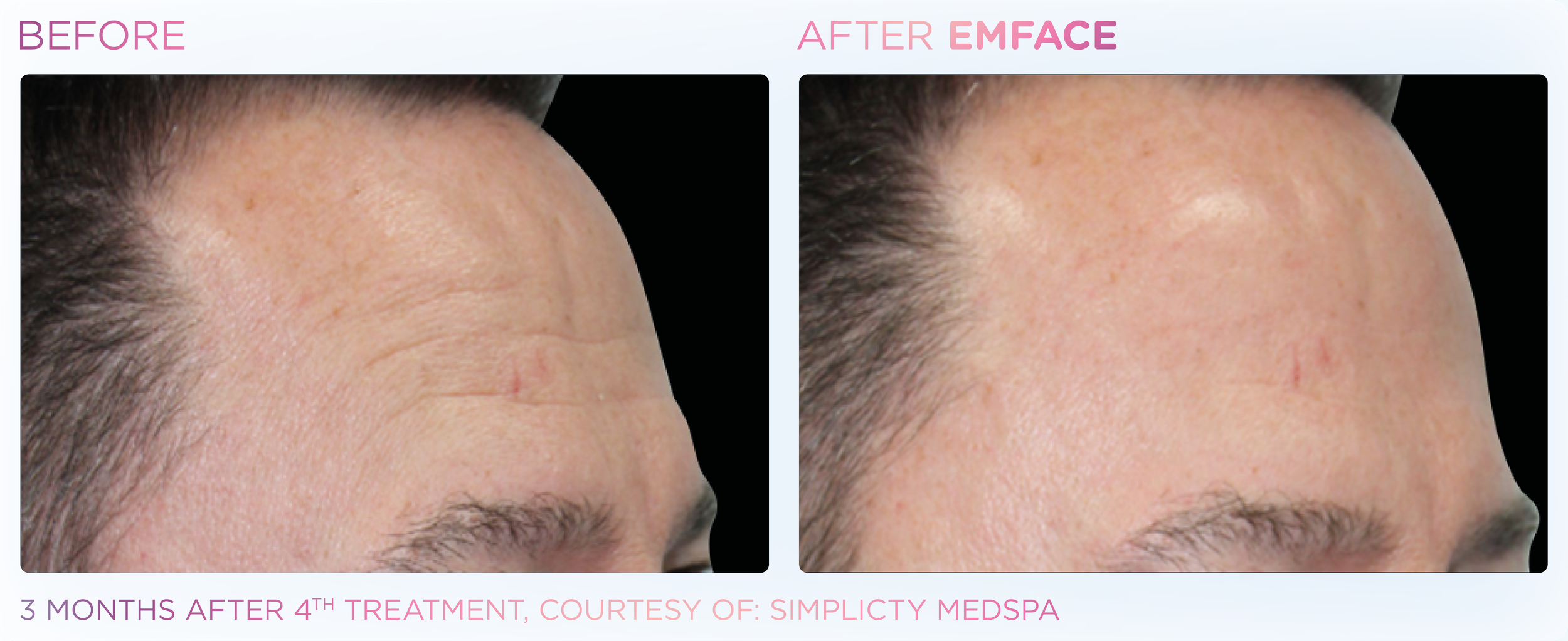 Comparison of a person's forehead before and after EMFACE treatment. The 'Before' side shows more visible wrinkles, while the 'After' side shows smoother, clearer skin with fewer wrinkles, three months after a skin treatment.