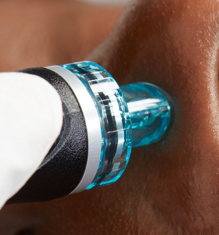 HydraFacial™ device using patented technology to cleanse, exfoliate, and hydrate the skin