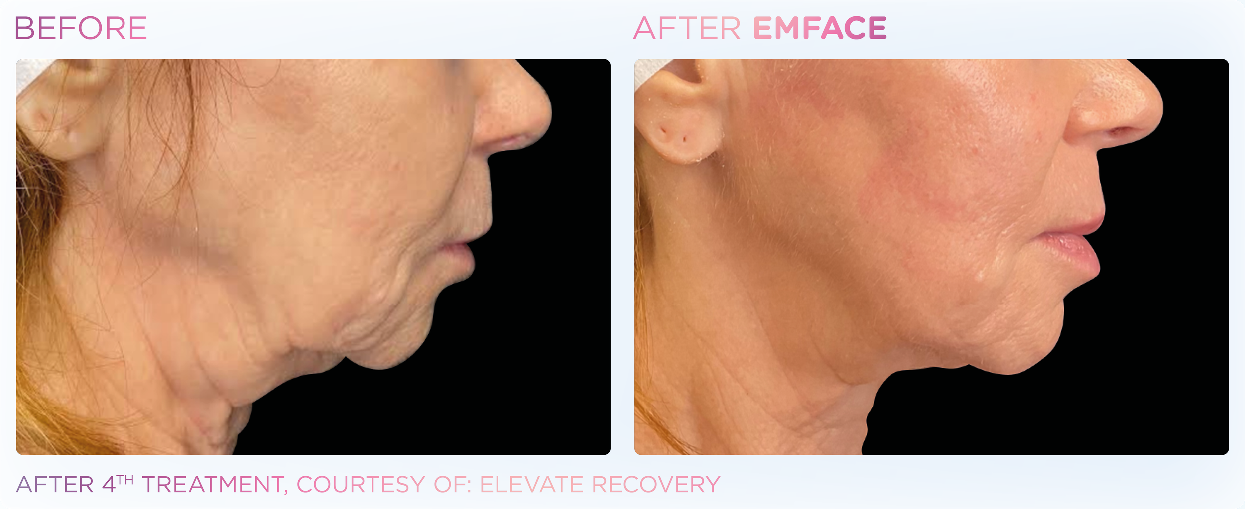 Side-by-side comparison of a woman's face before and after four EMFACE treatments showing a reduction in skin sagging and wrinkles.