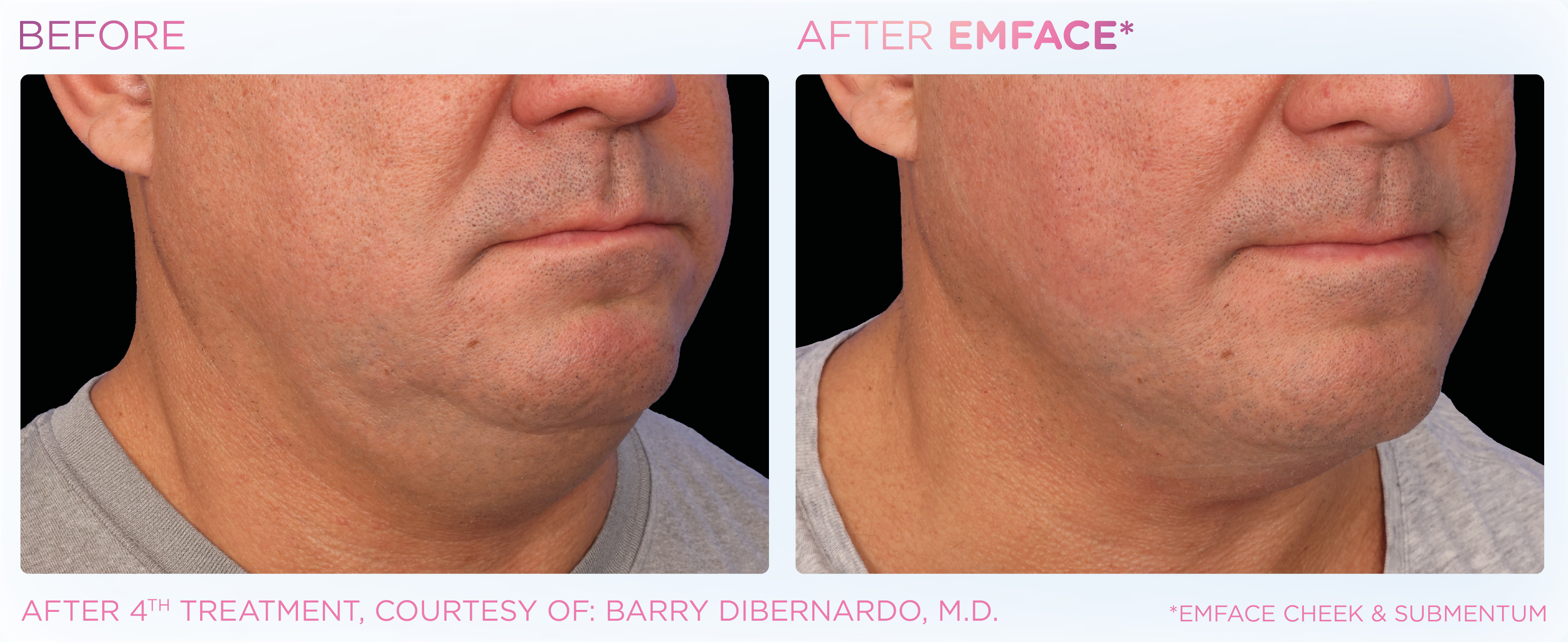 Side-by-side comparison of a man's lower face before and after EMFACE treatment showing reduced double chin.