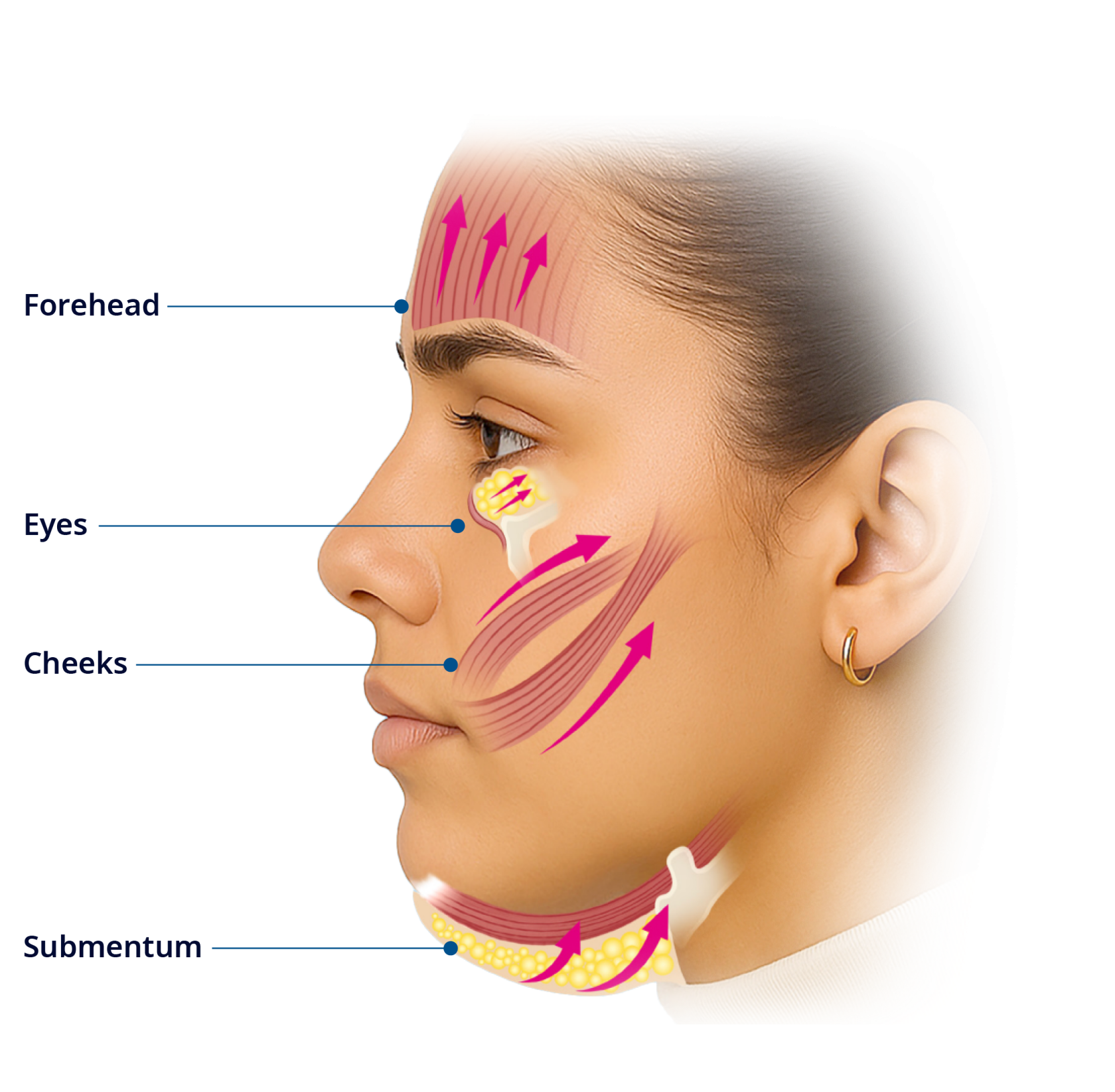 Face diagram showing the 4 treatment areas for EMFACE: Forehead, Eyes, Cheeks, and Submentum