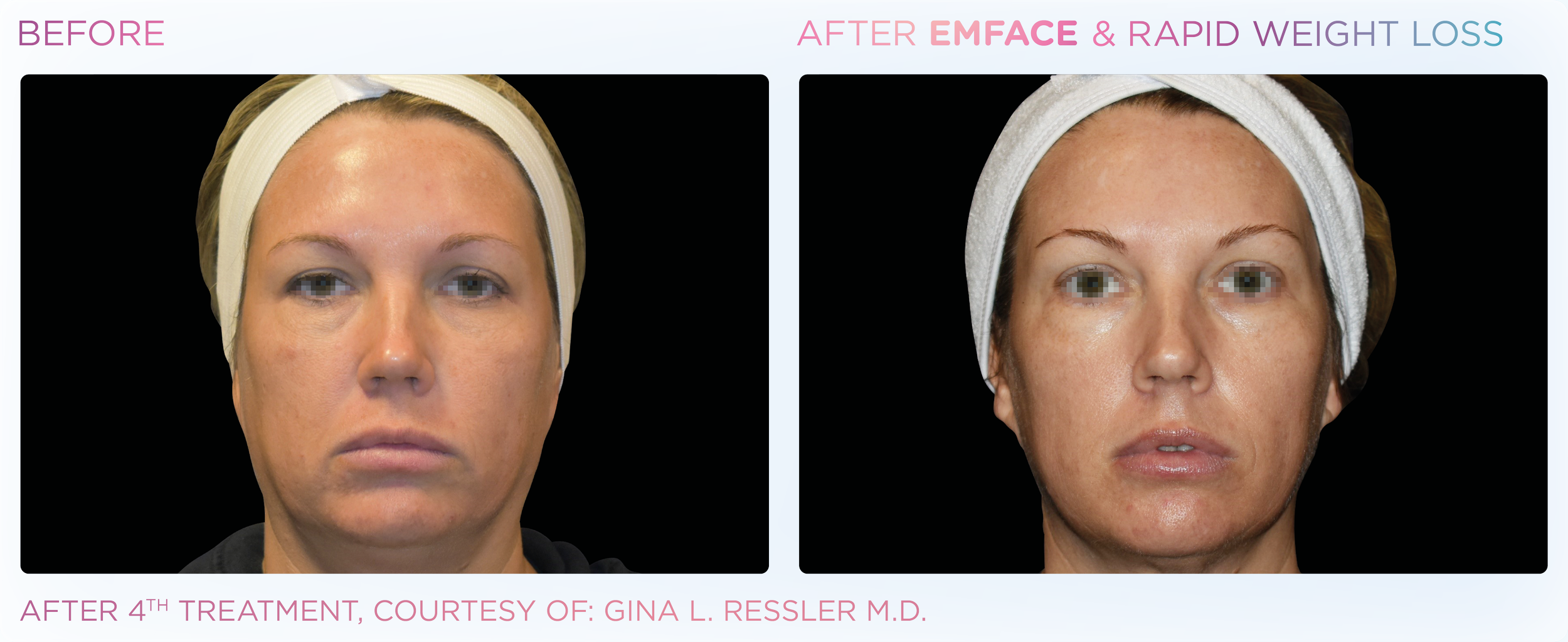 Side-by-side comparison of a woman's face before and after EMFACE treatment, showing improved facial structure and lift after four treatments.