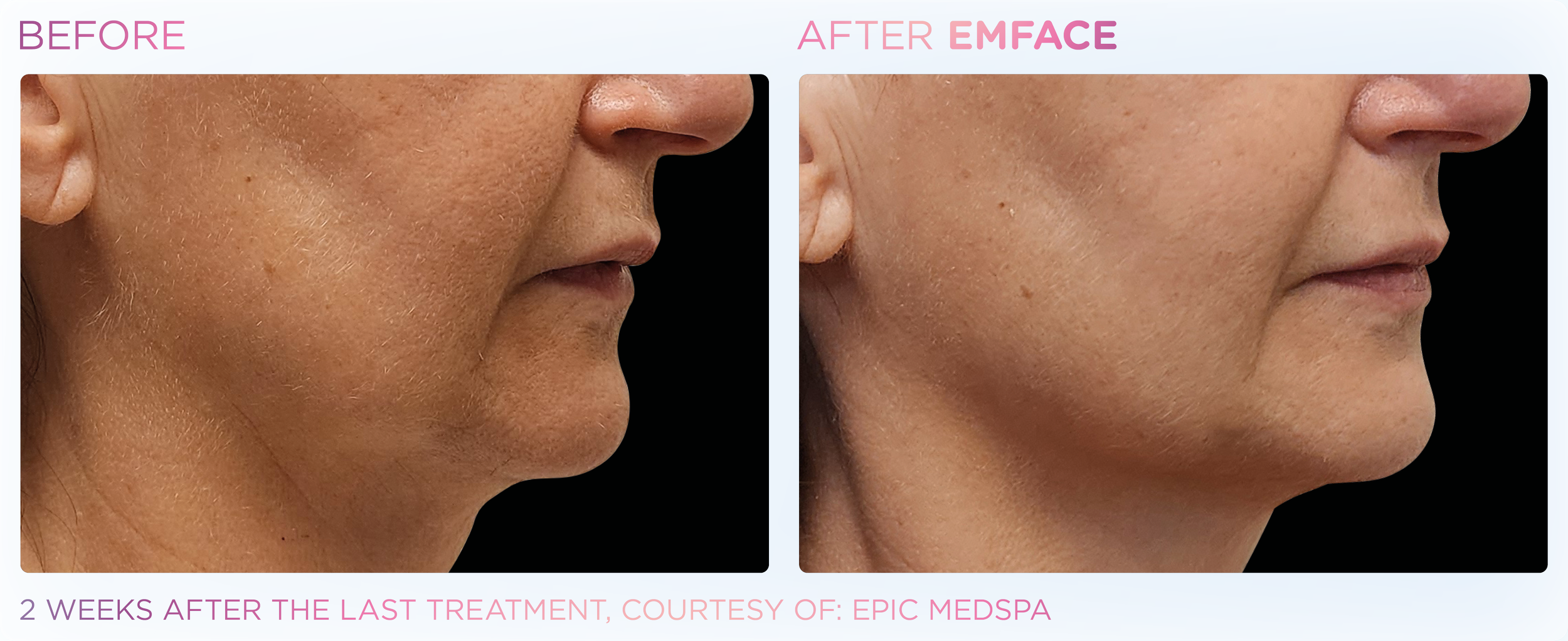 Side-by-side comparison of a woman's face before and after EMFACE treatment showing tighter jawline.