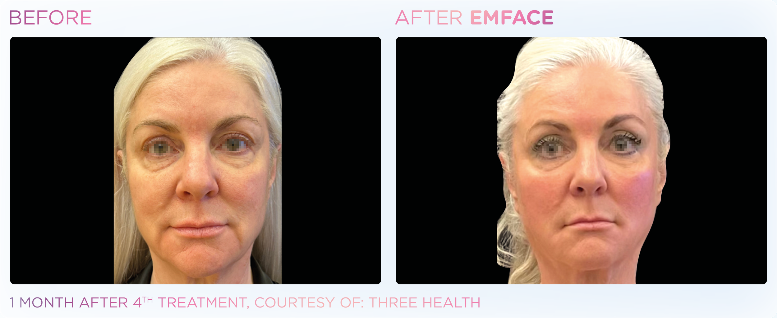 Side-by-side comparison of a woman's face before and after EMFACE treatment. The left image shows signs of aging  while the right image shows smoother, more youthful skin with an improved complexion. 