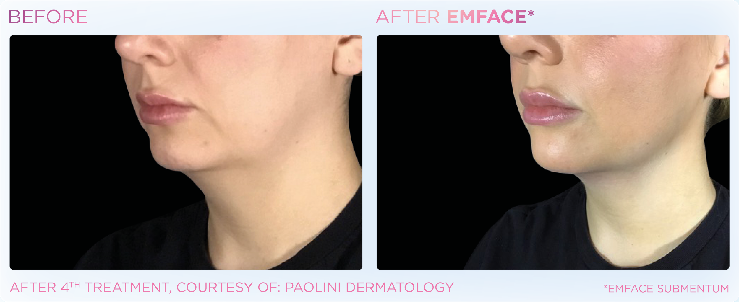Comparison of a woman's chin before and after four EMFACE treatments showing a more defined jawline.