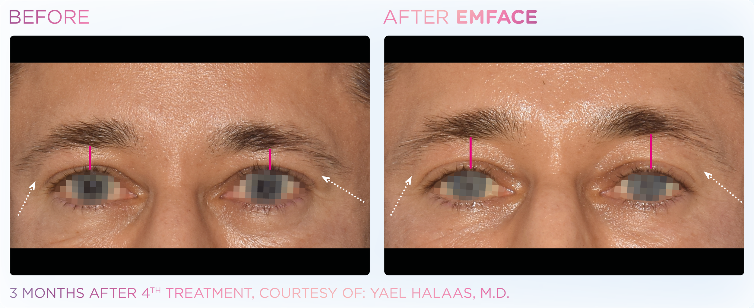 Comparison of a person's eyes before and after EMFACE treatment showing improved brow lift and placement.