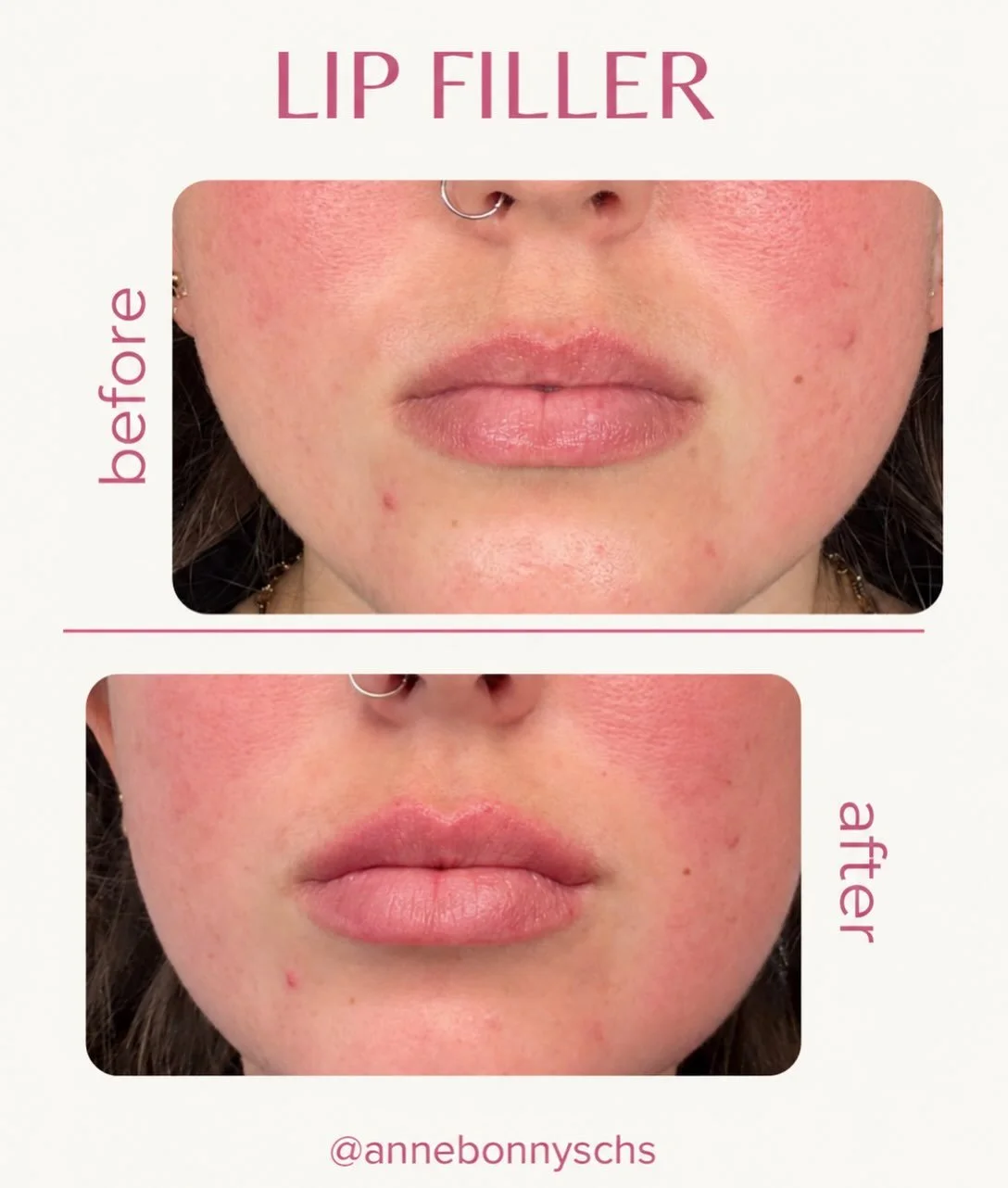 A little added fullness, with her natural lip shape still taking center stage. We used JUV&Eacute;DERM&reg; VOLBELLA&reg; XC for this enhancement 💋 loving the results. Every treatment is tailored to your anatomy and goals. Be sure to book your appoi
