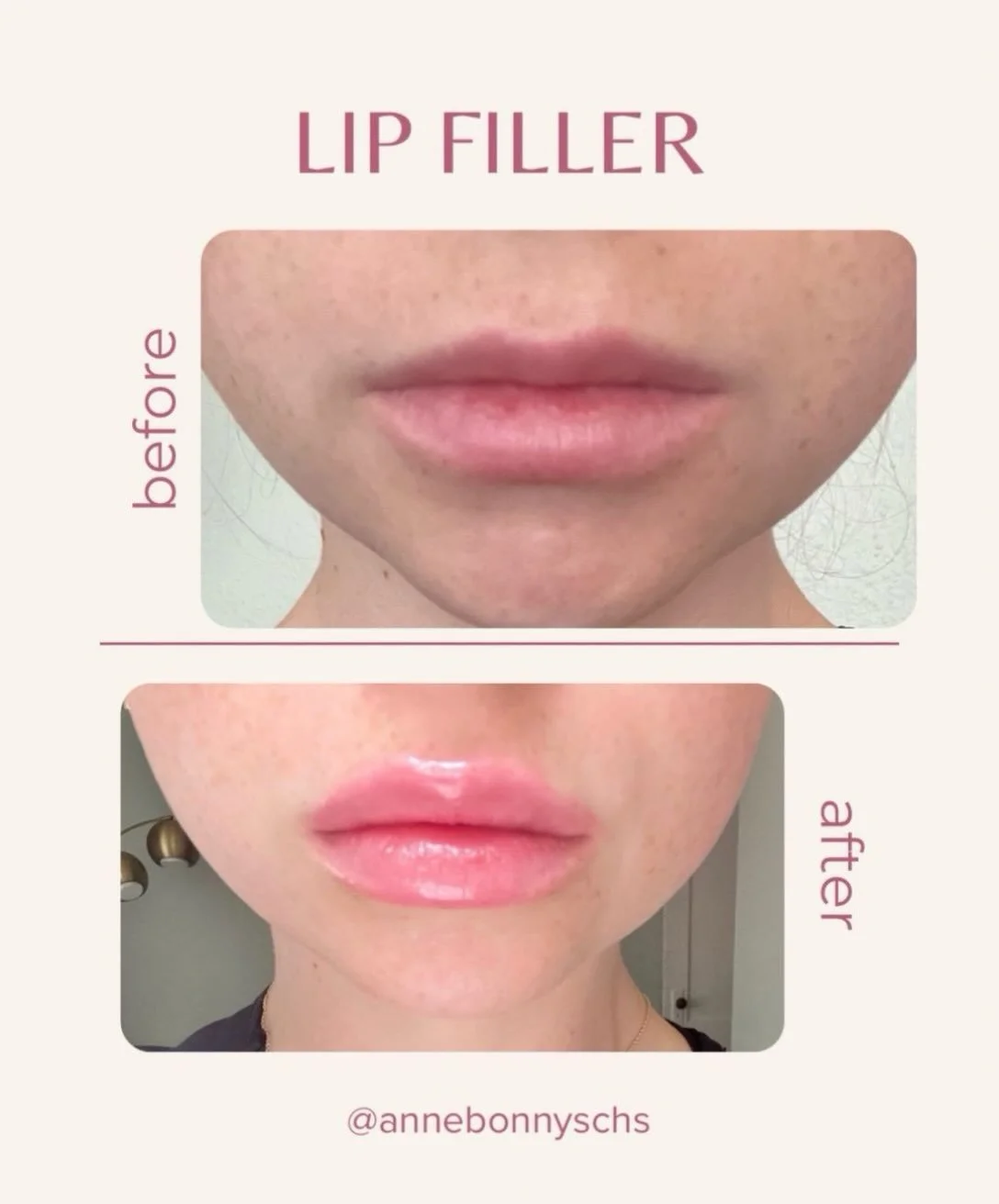 Filler Friday 💋 A little more fullness, a little more definition&mdash;loving this before + after!

Thinking about lip filler? Let&rsquo;s talk about your goals. DM us to book a consultation at Anne Bonny&rsquo;s 🤍

#FillerFriday #CharlestonLipFill