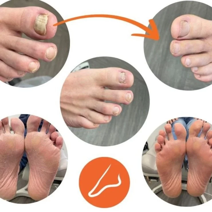 Fongyl Fungal Nail — The Foot Company