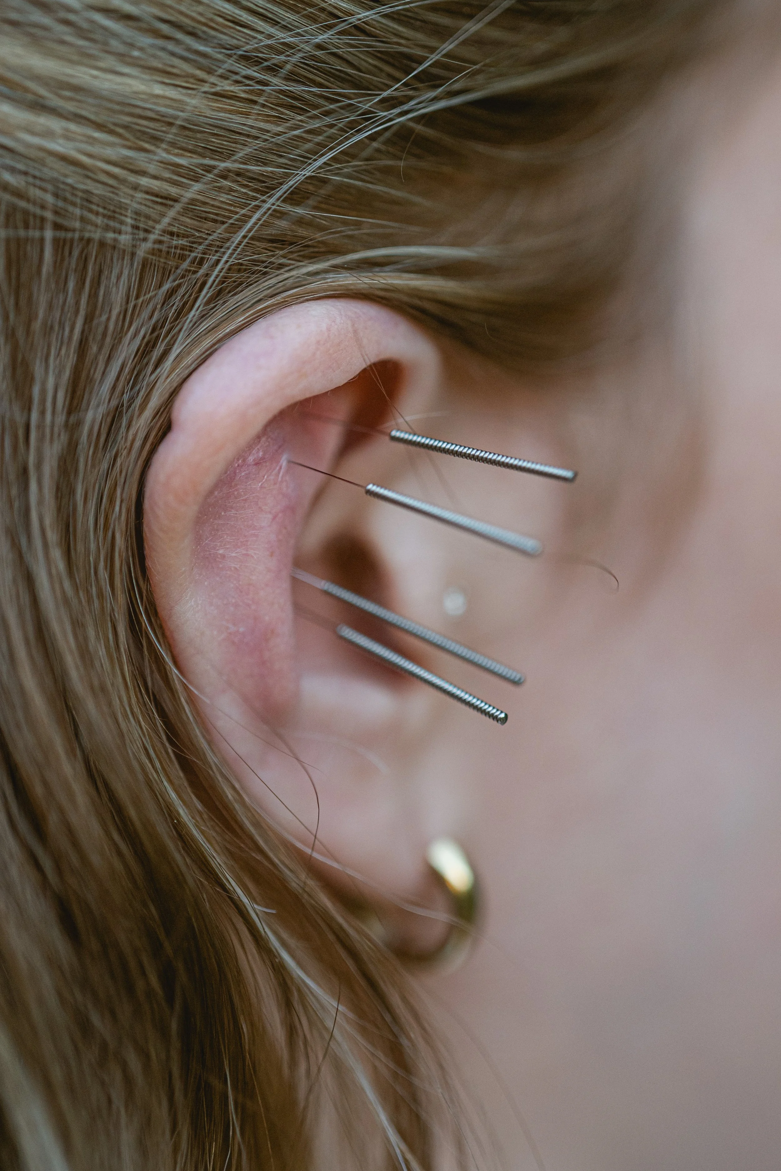 Group Acupuncture & Meditation