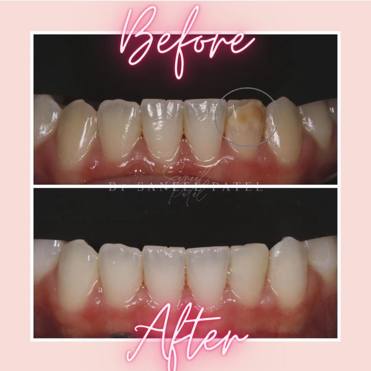 ICON treatment to remove discolouration with composite bonding produces stunning results!
🦷
Wonderful before and after by Saneel at @waysidedentalpractice .
😀
Call reception to book a smile consultation today on 01582 712470!
✨
For more information