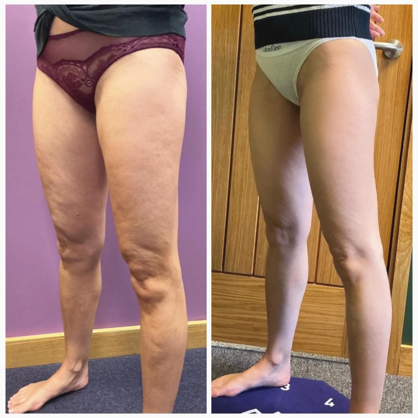 Another amazing client transformation with our member @theal5aesthetics Ultimate Cellulite Buster Course! 
👏
Their powerful 6-week treatment course combines: Emerald Fat Loss Laser Helps shrink stubborn fat cells, improve circulation, and smooth the