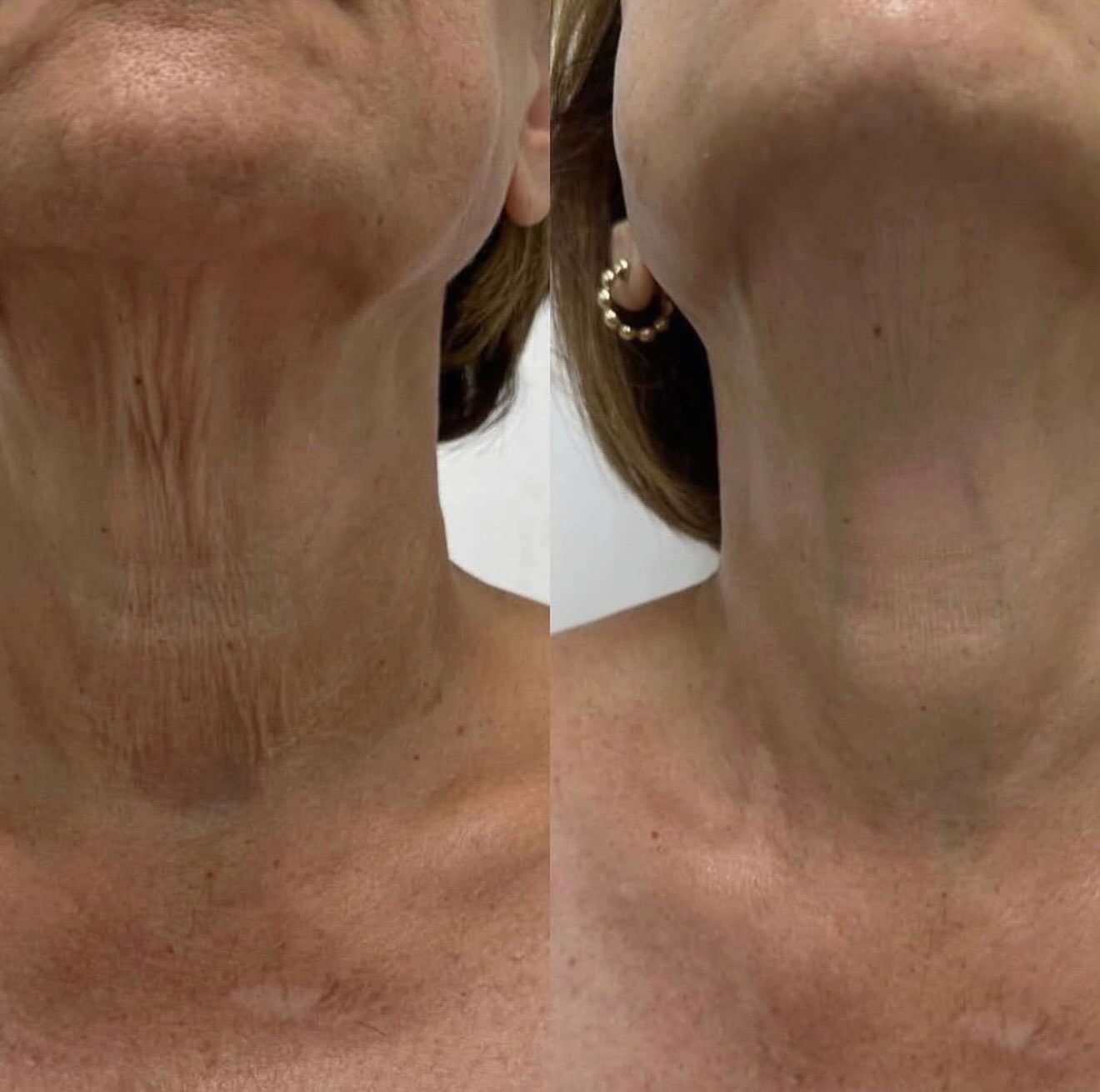 ✨ The neck transformation everyone&rsquo;s talking about... ✨

These results are after just 3 Ultralase MD BabyFace Neck Treatments, with our member @theal5aesthetics 
⚡️
Using advanced fractional thulium laser technology, BabyFace stimulates collage