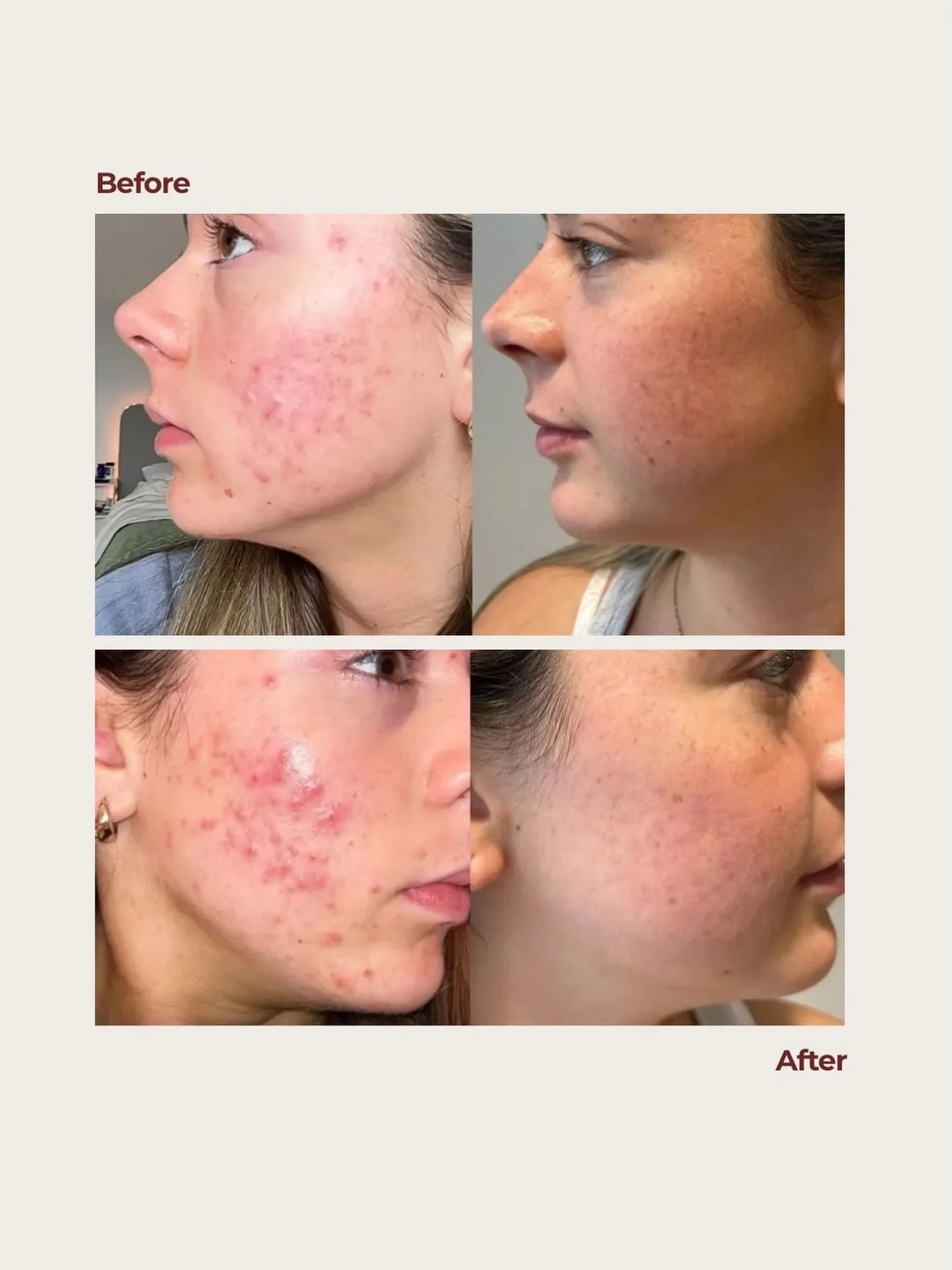 🌟 The image speaks for itself. 🌟 

Our member @drsharoncrichlow says it&rsquo;s always rewarding to see results like these.
🗣️ 
This patient was treated medically using a combination of topical treatments and isotretinoin, with excellent improveme
